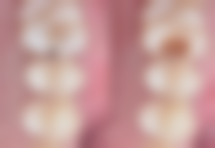 临汾现代妇产医院植发科实例参考