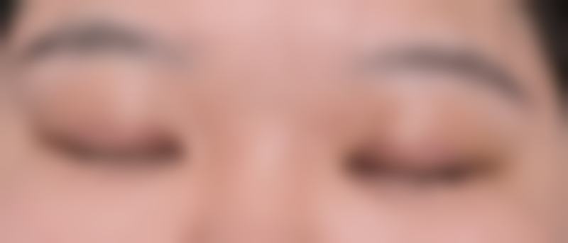 南京艺星双眼皮手术成功案例-荔枝美